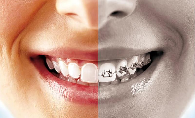 Braketlerle neler yenilebilir?